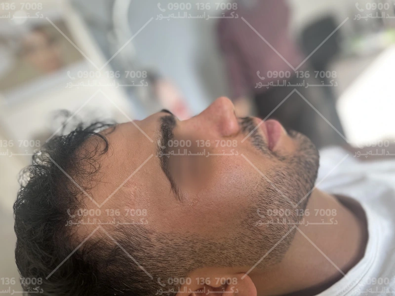 نحوه چسب زدن به بینی نحوه چسب زدن به بینی