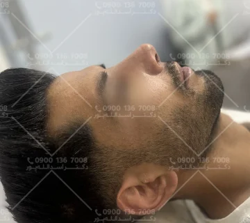 مصرف قرص آهن قبل از جراحی بینی دکتر اسدالله پور