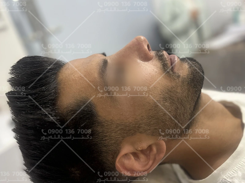 مصرف قرص آهن قبل از جراحی بینی دکتر اسدالله پور