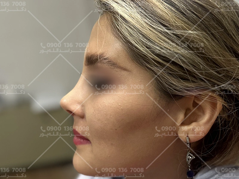 علت چرب شدن پوست صورت بعد از جراحی بینی دکتر اسدالله پور