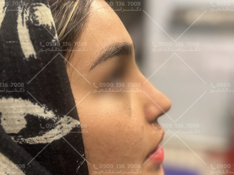 خطرات بیهوشی در جراحی بینی دکتر اسدالله پور