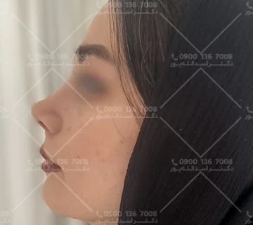 بهترین سن عمل بینی دکتر اسدالله پور