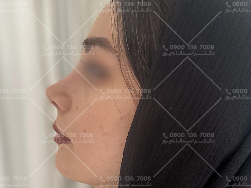 بهترین سن عمل بینی دکتر اسدالله پور