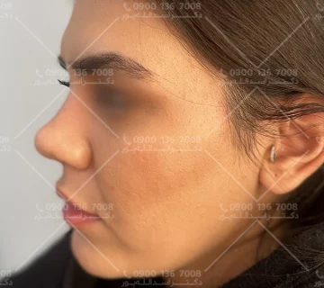 چسب نزدن بعد از جراحی بینی دکتر اسدالله پور