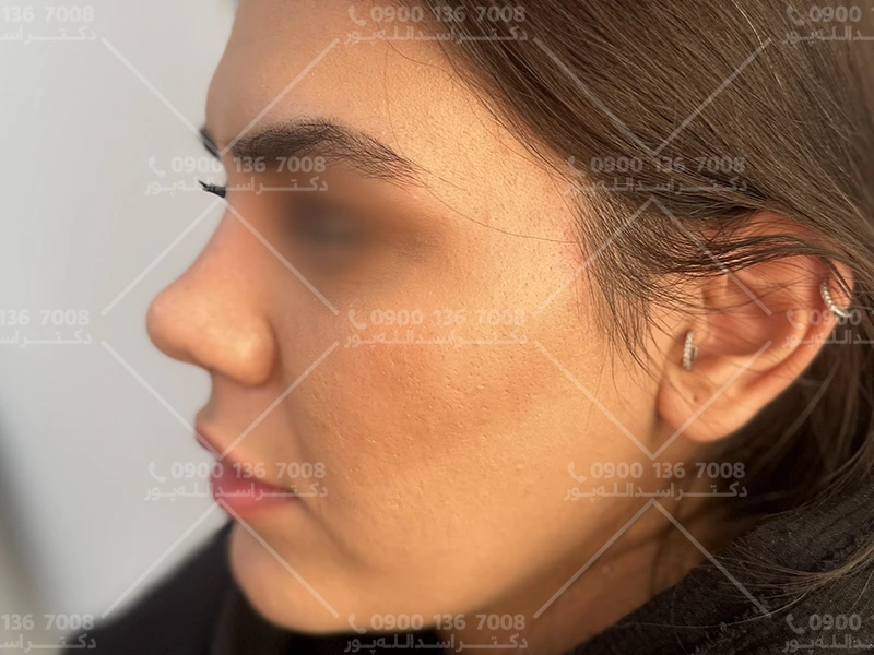 چسب نزدن بعد از جراحی بینی دکتر اسدالله پور