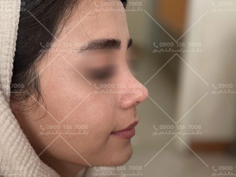 نحوه خوابیدن بعد از جراحی بینی دکتر اسدالله پور