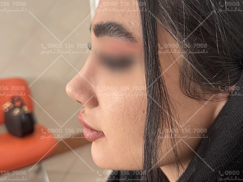 قرص آناهیل بعد از جراحی بینی دکتر اسدالله پور