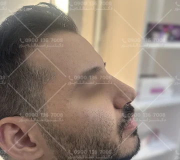 تحرک و ورزش بعد از عمل جراحی بینی دکتر اسدالله پور