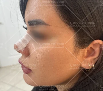 گرفتگی بینی بعد از جراحی بینی دکتر اسدالله پور
